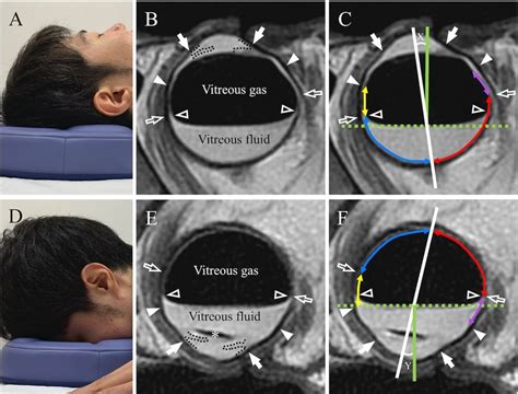 Positions During Mri Examination And Mri Images In The Supine And Prone