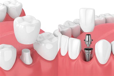 Are Dental Implants or Dental Crowns Better? | CarolinasDentist