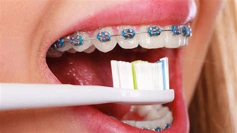 ¿Cómo Cepillarse los Dientes con Brackets? - Amparo Aguirre