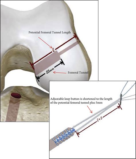 Minimally Invasive Quadriceps Tendon Harvest And Graft Preparation For