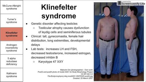 Complete Androgen Insensitivity Syndrome Models