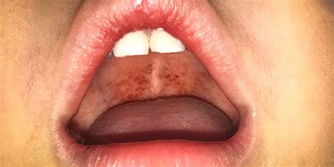 Tiny White Spots On Throat Not Strep