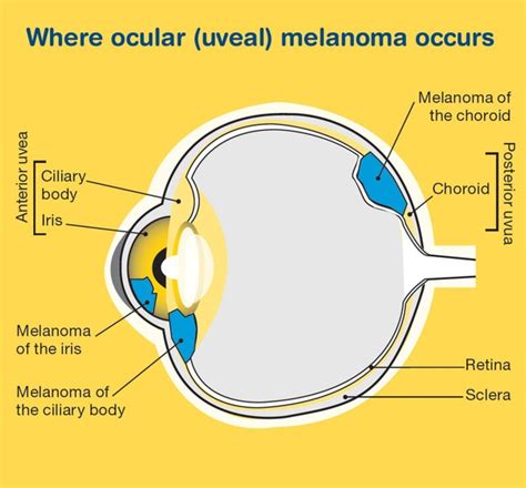 Ocular Melanoma | Causes, Symptoms, Treatments