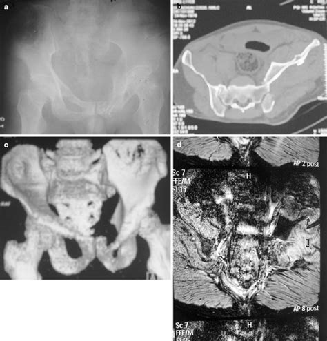 A Radiograph Showing The Sacroiliac Fracture Dislocation With Fractures