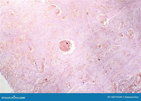 Capillary Hemangioma Light Micrograph Stock Image Image Of Histology