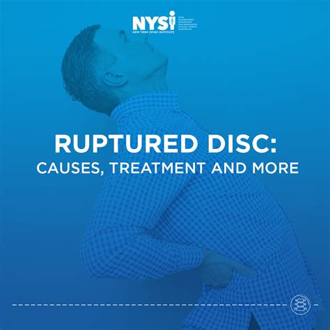 Ruptured Disc Spinal Pain Treatment | New York Spine Institute