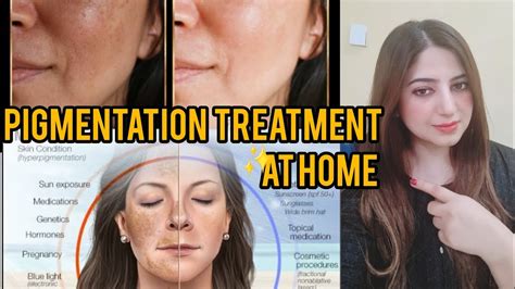 How To Remove Melasma Hyperpigmentation At Home Within Days Youtube