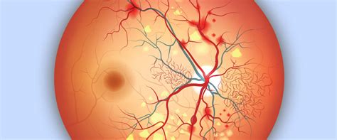 Retinopatia Diabetica E Demenza Locchio Una Finestra Sul Cervello Per