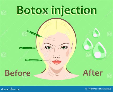 Ejemplo Del Vector De La Cirug A Cosm Tica Inyecci N De Botox