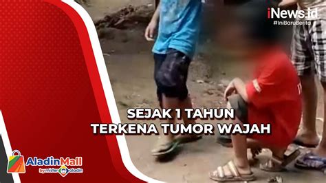 Berita Tumor Wajah Terkini Dan Terbaru Hari Ini INews