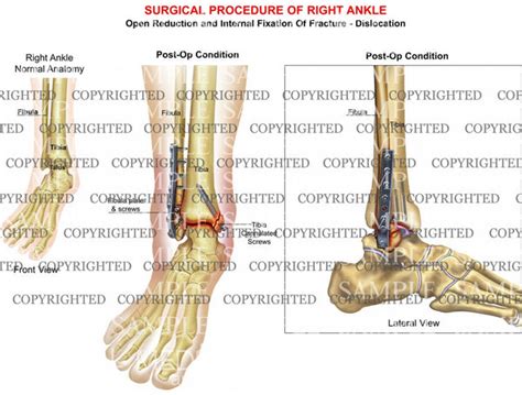 Icd 10 Code For Non Union Fibula Fracture