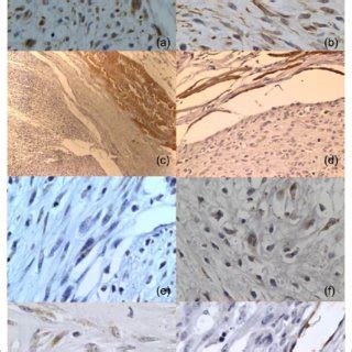 Photomicrographs Of Immunohistochemical Expression Of Vimentin Desmin