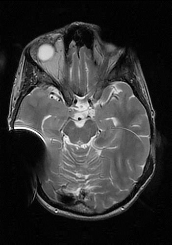 Mr Imaging And Cochlear Implants With Retained Internal Magnets