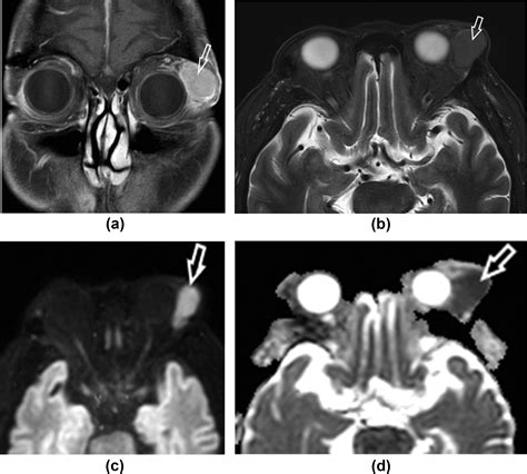 Imaging Of IgG4 Related Disease Of The Head And Neck Clinical Radiology