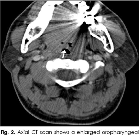 Figure 2 From A Second Branchial Cleft Cyst Of Palatine Tonsil Semantic Scholar