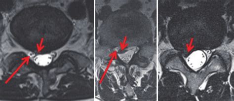 (A) Axial plane of a MRI (t2-sequence) of a lumbar spine. Nerve root... | Download Scientific ...