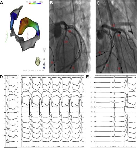 A Electroanatomic Mapping Showing Earliest Site Of Activation At The