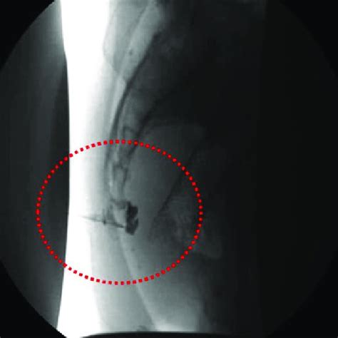 Ganglion impar neurolysis procedure part 1: needle placement (circle ...