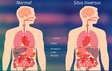 Situs inversus definition, causes, symptoms, diagnosis & treatment