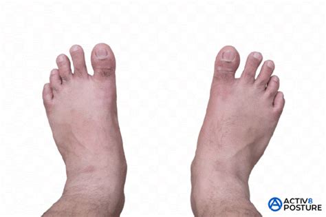 Can You Really Fix Flat Feet Unraveling The Posture Connection