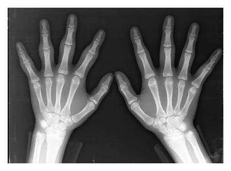 Plain Radiograph Of Bilateral Hands At The First Examination No Bony