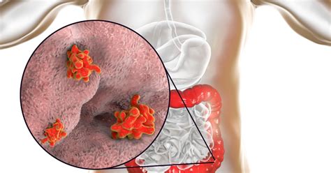 Amebíase Entamoeba histolytica ciclo sintomas tratamento