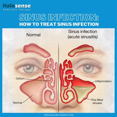 Sinus Infection How To Treat Sinus Infection Halosense Salt