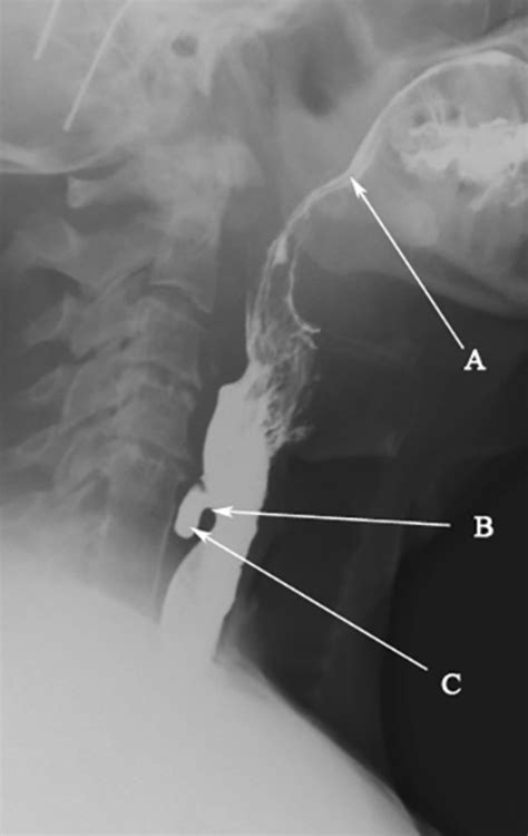 Anatomy Of A Swallow The Bmj