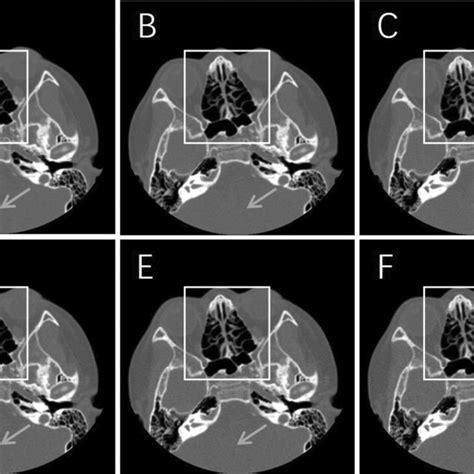 Axial CT Soft Tissue Window Images From Different Reconstruction