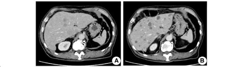 Ct Scan Showed Diffuse Liver Metastases Before Treatment A Cystic