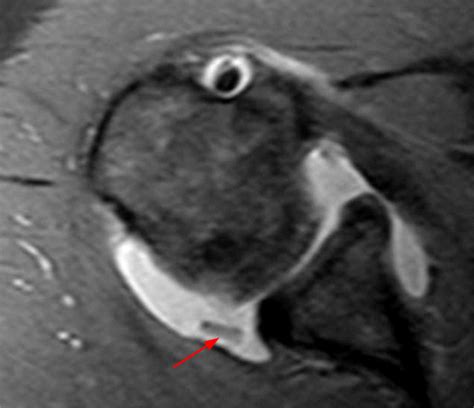 Chondrolysis of the Glenohumeral Joint | Radsource