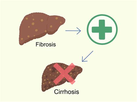 6 formas de tratar la fibrosis hepática wikiHow