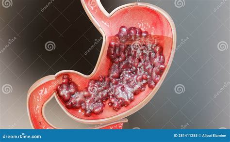 Stomach Cancer Stages Tumor Growth In Digestive System Peptic Ulcer