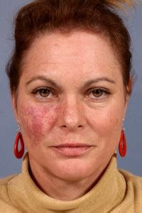 Laser Treatment for Facial Redness and Broken Blood Vessels