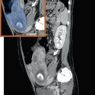 A Abdominal Contrast Enhanced Computed Tomography Ct Coronal View