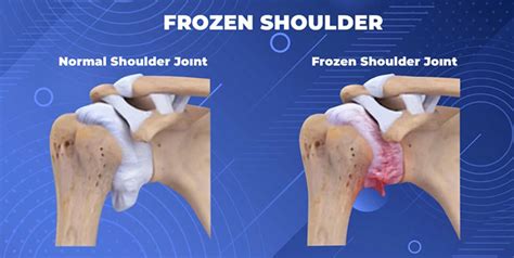 Frozen Shoulder Causes Symptoms Treatment And Orthopaedic Care In