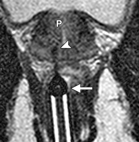 Imaging Guided Prostate Biopsy Conventional And Emerging Techniques Radiographics