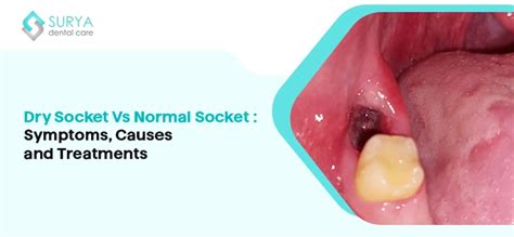 Dry Socket Vs Normal Socket Symptoms Causes And Treatments