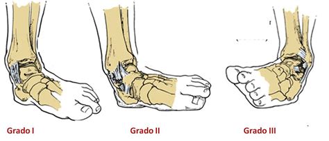 Tratamiento Esguince Tobillo S Ntomas Y Grados