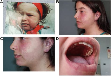 A: Patient 2 at 3 years of age. The paired twin nevi (telangiectatic... | Download Scientific ...