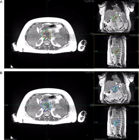 A Practical Workflow For Magnetic Resonanceguided Stereotactic Body