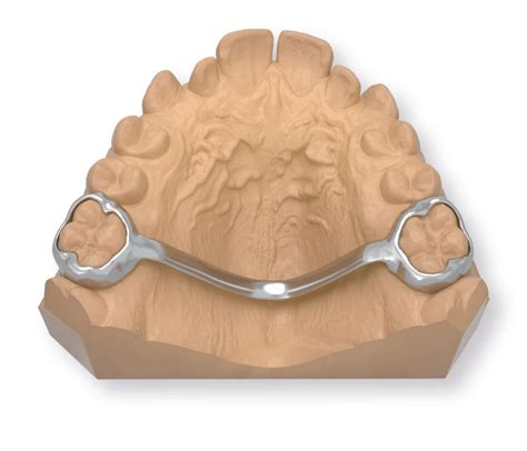 Digital Transpalatal Arch