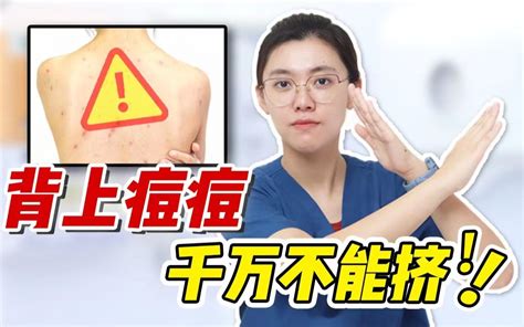 后背痒？后背长痘老不好？螨虫被迫背锅！ 皮肤科医生禹汐 皮肤科医生禹汐 哔哩哔哩视频