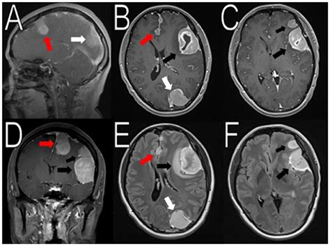 Frontiers Somatic SMARCB1 Mutation In Sporadic Multiple Meningiomas