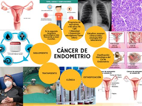 Cancer Endometrio Infografia Docsity