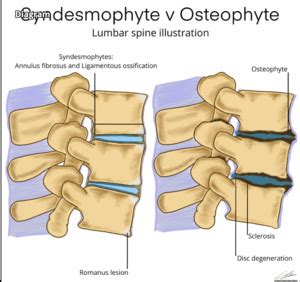 Osteophyte - Physiopedia