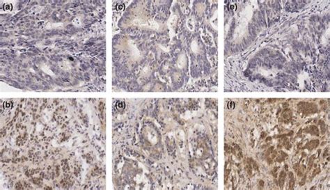 Representative Examples Of Immunohisto Chemical Staining In Colorectal