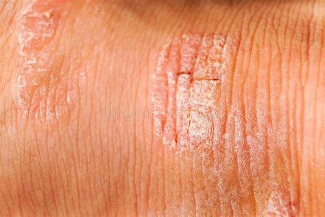 Psoriasis Dry Red And White Irritation On The Skin Closeup Stock Image