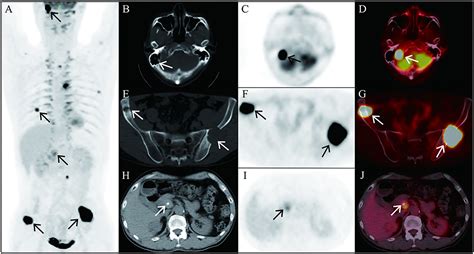 Frontiers 18F FDG PET CT In A Patient With Malignant Pheochromocytoma