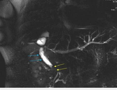 Mrcp Shows Dilated Common Bile Duct Cbd With Filling Defect Yellow